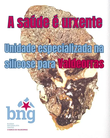 nova_silicose